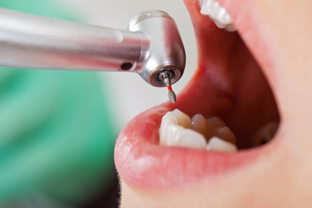 Best Emergency Root Canal Treatment in Milan, OH